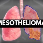 Mesothelioma