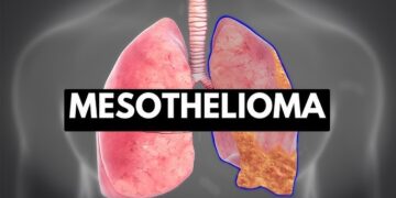 Mesothelioma