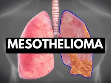 Mesothelioma