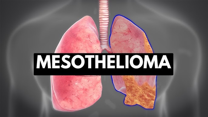 Mesothelioma and Fertility: Overlooked Reproductive Health Risks